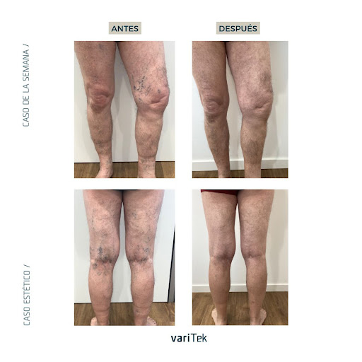 Varitek Sevilla - Tratamiento de varices sin cirugía